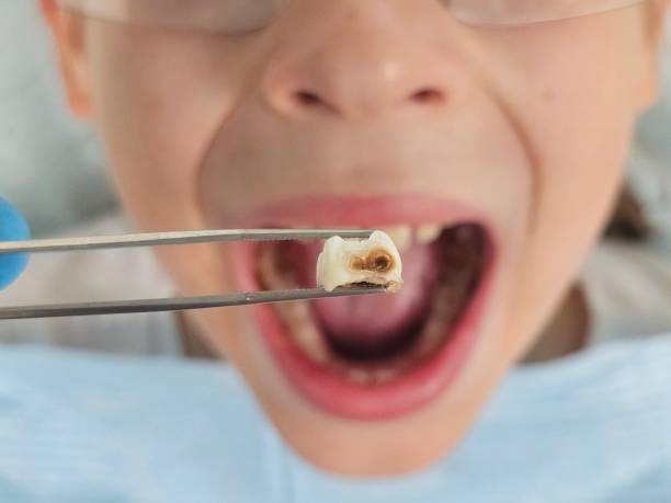 Best Emergency Treatment for Dental Infections or Abscesses in Sevierville, TN